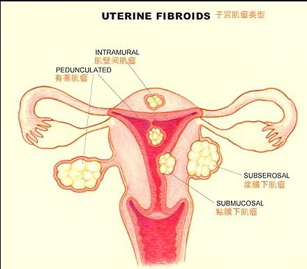 子宫肌瘤分类（宁波新东方医院图示)