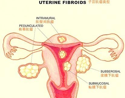 子宫肌瘤分类图示